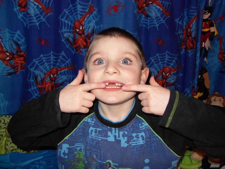 Gappy Teeth!